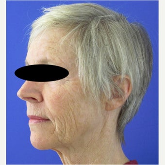 55-64 year old woman treated with CO2 Laser, Smartlipo, Filler and Xeomin before 2637262