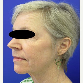 55-64 year old woman treated with CO2 Laser, Smartlipo, Filler and Xeomin after 2637262