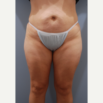 35-44 year old woman treated with Tummy Tuck before 3590134
