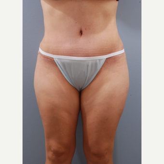35-44 year old woman treated with Tummy Tuck after 3590134