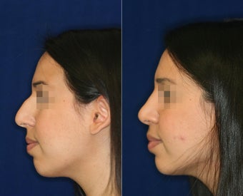 Nose Surgery before 1430762