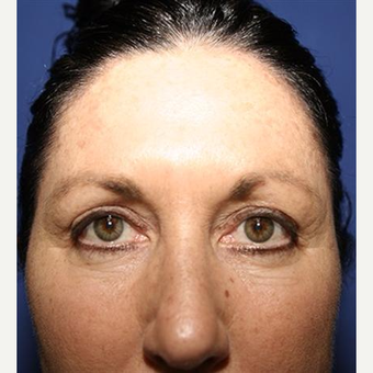 45-54 year old woman treated with Eyelid Surgery before 3093403