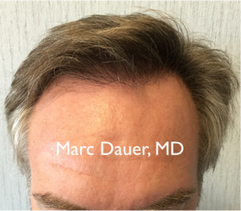 45-54 year old man treated with Hair Transplant after 3371779