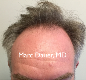 45-54 year old man treated with Hair Transplant before 3371779