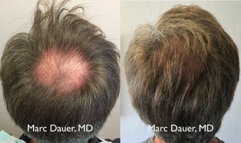 45-54 year old man treated with Hair Transplant 3371779