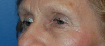 Lower Blepharoplasty 1181653