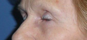 Lower Blepharoplasty 1181653