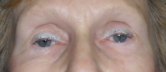 Lower Blepharoplasty after 1181653