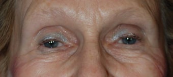 Lower Blepharoplasty before 1181653