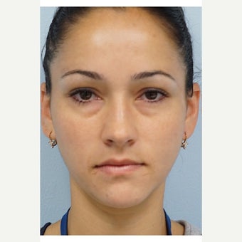 25-34 year old woman treated with Restylane before 2495461