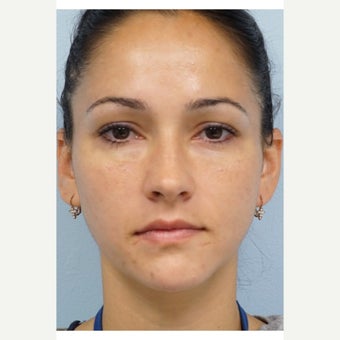 25-34 year old woman treated with Restylane after 2495461