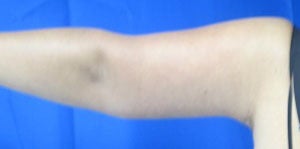 Arm Lift after 3094433