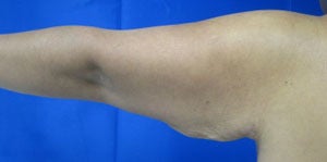 Arm Lift before 3094433