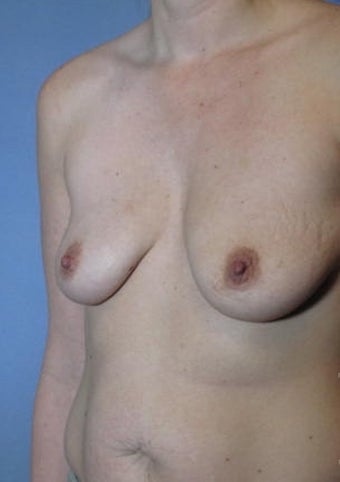 35-44 year old woman treated with Breast Lift with Implants before 2038594