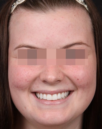 Acne Treatments for Teenage Breakouts after 1350563