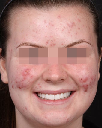 Acne Treatments for Teenage Breakouts before 1350563