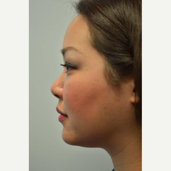 25-34 year old woman treated with Non Surgical Nose Job before 3687978