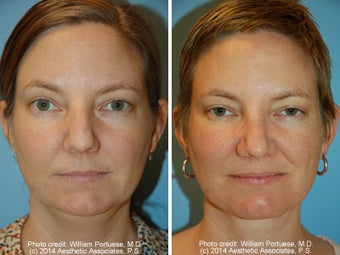 Neck Liposuction before 1389500
