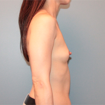 45 year old woman had breast augmentation with 305cc Sientra Breast Implants before 3389784
