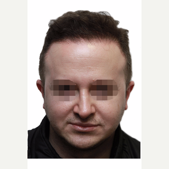 35-44 year old woman treated with Hair Transplant after 3280112
