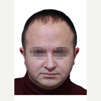35-44 year old woman treated with Hair Transplant before 3280112