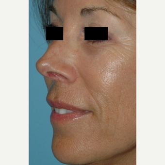 55-64 year old female treated with Microneedling before 2882847
