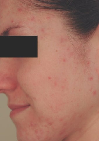 Hormonal Acne Treatment in Los Angeles before 82987