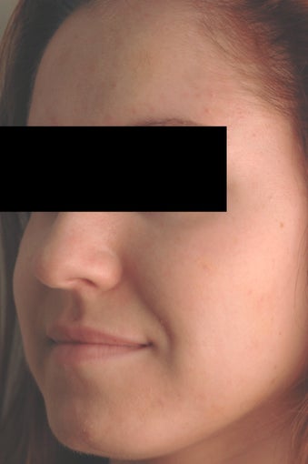 Hormonal Acne Treatment in Los Angeles after 82987