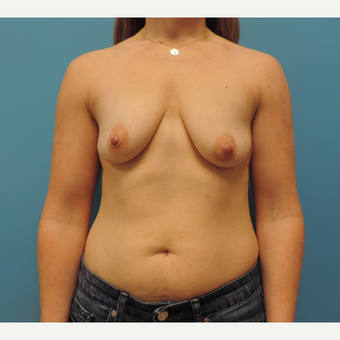 25-34 year old woman treated with Breast Lift with Implants before 3578208