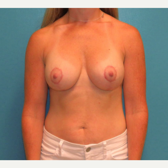 25-34 year old woman treated with Breast Lift with Implants after 3578208