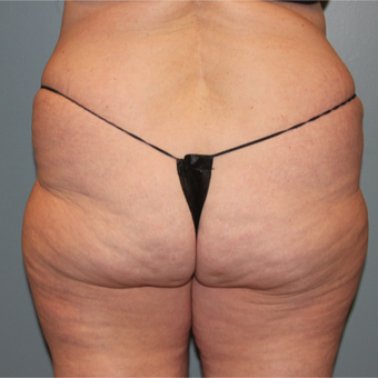57 year old woman treated with Cellfina for cellulite after 3467389
