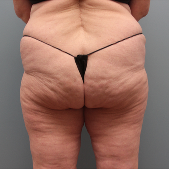 57 year old woman treated with Cellfina for cellulite before 3467389