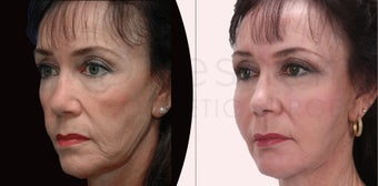 60 year old woman facial fat grafting to restore volume before 1127808