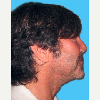 Neck Lift after 3824737