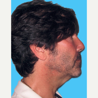 Neck Lift before 3824737