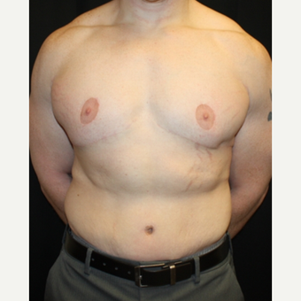 35-44 year old man treated with Male Tummy Tuck after 2618831