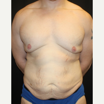35-44 year old man treated with Male Tummy Tuck before 2618831