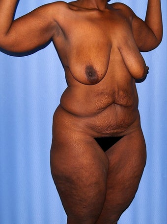 45-54 year old woman treated with Body Lift 2737576