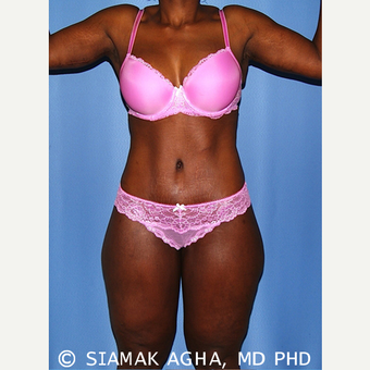 45-54 year old woman treated with Body Lift after 2737576