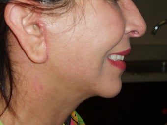 50's y/o female with discoloration and thick sagging face/neck skin after 1331603
