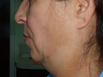 50's y/o female with discoloration and thick sagging face/neck skin 1331603