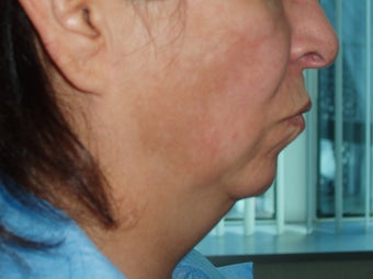 50's y/o female with discoloration and thick sagging face/neck skin before 1331603