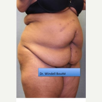 45-54 year old woman treated with Liposuction before 1651814