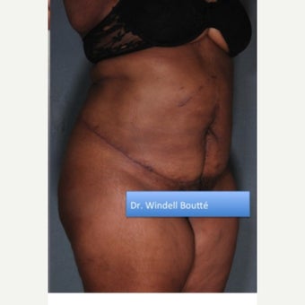 45-54 year old woman treated with Liposuction after 1651814