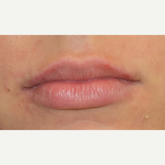 18-24 year old woman treated with Juvederm after 3749628