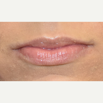 18-24 year old woman treated with Juvederm before 3749628