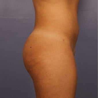 18-24 year old woman treated with Brazilian Butt Lift after 2593632