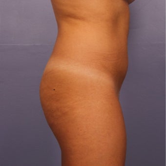 18-24 year old woman treated with Brazilian Butt Lift before 2593632