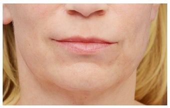 Lower Face Lift before 1284141