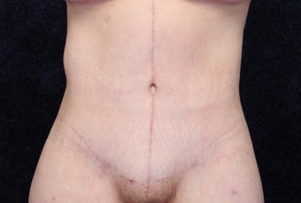 35 Year Old Female, Beltlift After Gastric Bypass after 1409503